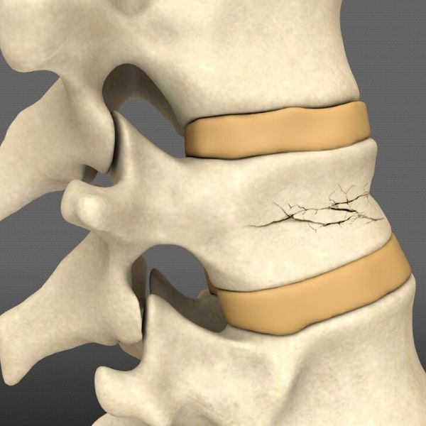 Vertebroplastie / Tratament dureri coloana vertebrala fracturi de compresie