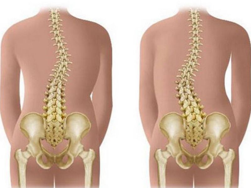 durere severă la spate și la coloana vertebrală