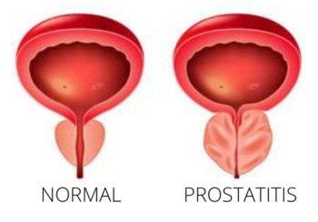 simptomele prostatitei cronice congestive furacilină pentru prostatită