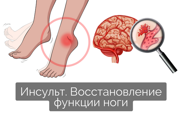 Ходьба после инсульта. После инсульта как восстановиться. Правая сторона инсульт восстановление рука и нога. ЛФК после инсульта рисунок ноги.