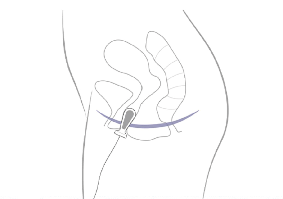 BioLito, медицинский аппарат для лечения недержания мочи и болей в области малого таза — изображение 3